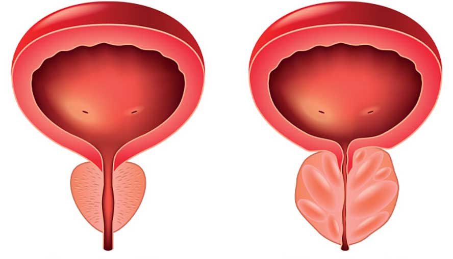 hiperplazija prostate